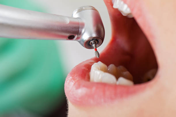 Best Emergency Treatment for Dental Infections or Abscesses in Tomball, TX